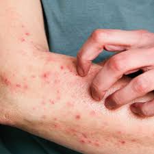 Paraná confirma primeiro caso de Mpox em 2026; atendimento ocorreu em Foz do Iguaçu